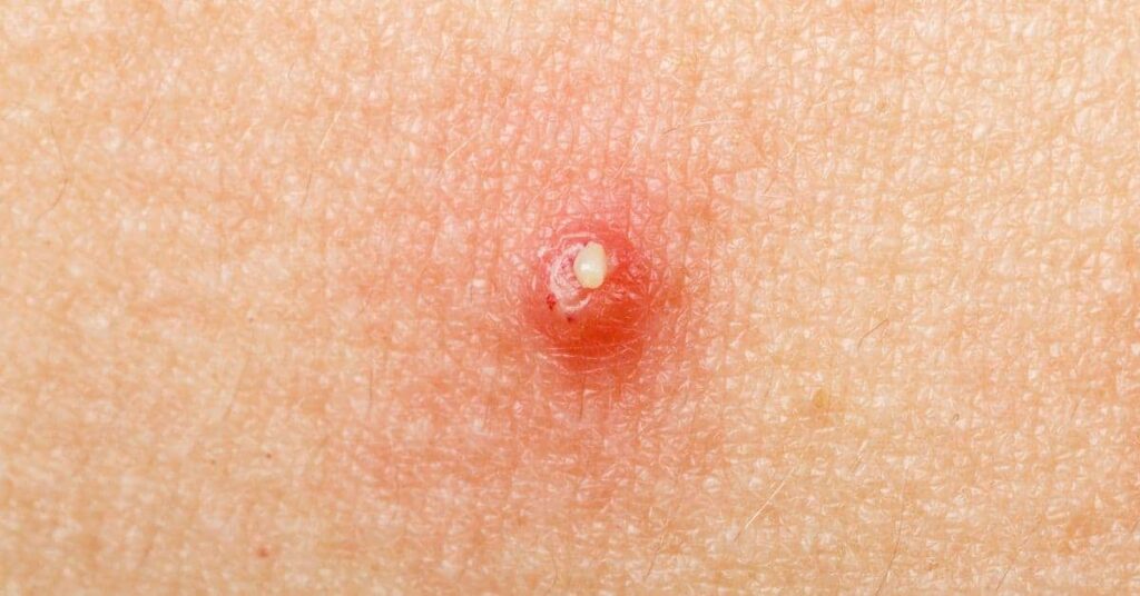 Cystic Acne Popping