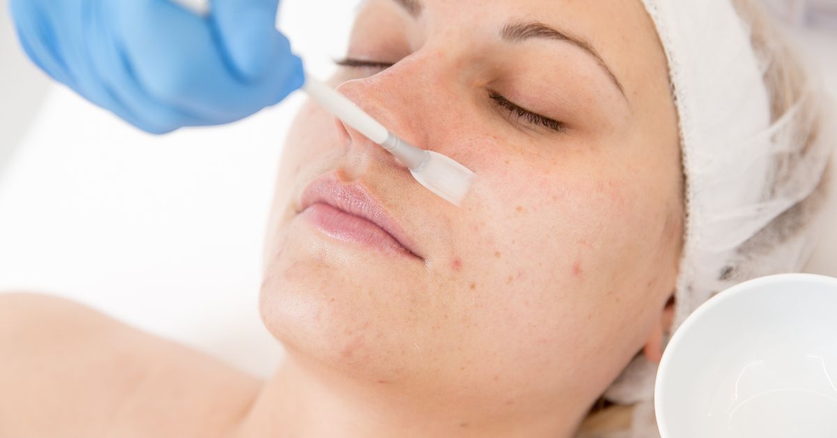 Best Moisturizer After Chemical Peel